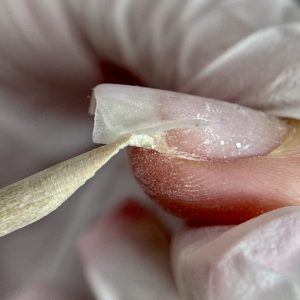 Tema 3 - Causas y soluciones del desprendimiento del esmalte